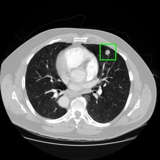 LUNG CANCER DETECTION AND ANALAYSIS WITH AI  – screenshot 5