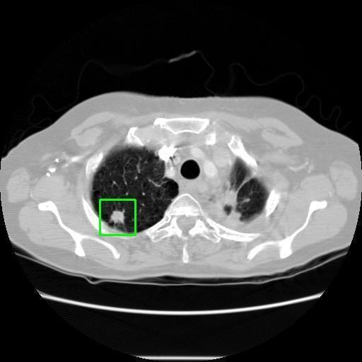 LUNG CANCER DETECTION AND ANALAYSIS WITH AI  – screenshot 8