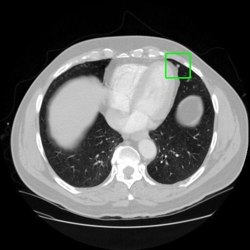 LUNG CANCER DETECTION AND ANALAYSIS WITH AI  – screenshot 9