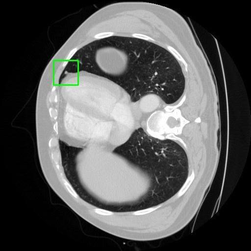 LUNG CANCER DETECTION AND ANALAYSIS WITH AI  – screenshot 10