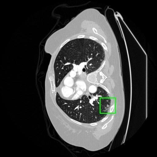 LUNG CANCER DETECTION AND ANALAYSIS WITH AI  – screenshot 11