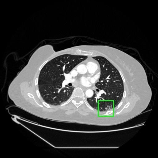 LUNG CANCER DETECTION AND ANALAYSIS WITH AI  – screenshot 12