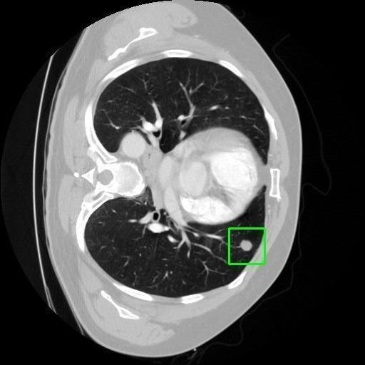 LUNG CANCER DETECTION AND ANALAYSIS WITH AI  – screenshot 13