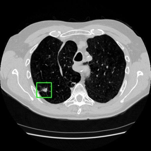LUNG CANCER DETECTION AND ANALAYSIS WITH AI  – screenshot 16