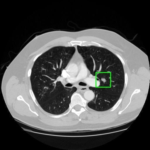 LUNG CANCER DETECTION AND ANALAYSIS WITH AI  – screenshot 17