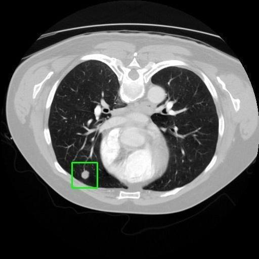 LUNG CANCER DETECTION AND ANALAYSIS WITH AI  – screenshot 18