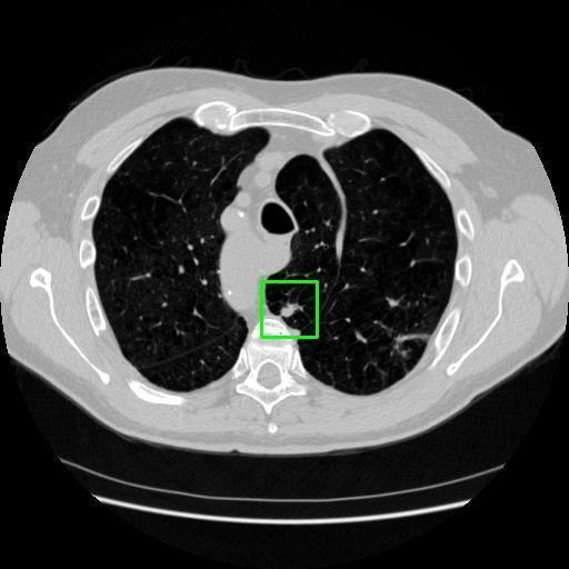 LUNG CANCER DETECTION AND ANALAYSIS WITH AI  – screenshot 19