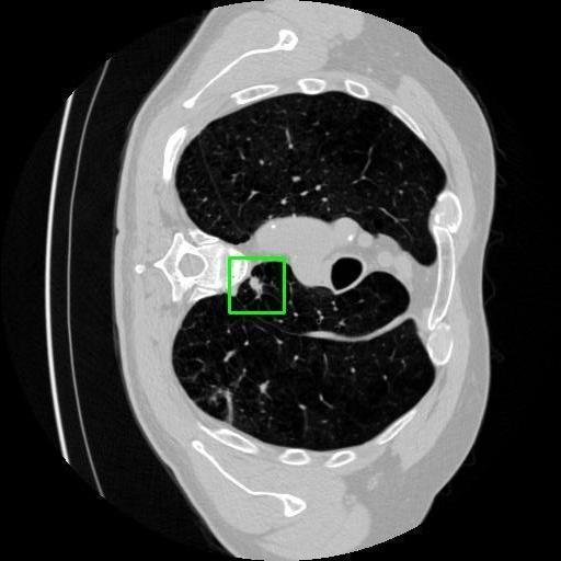 LUNG CANCER DETECTION AND ANALAYSIS WITH AI  – screenshot 20