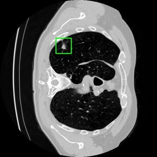LUNG CANCER DETECTION AND ANALAYSIS WITH AI  – screenshot 21