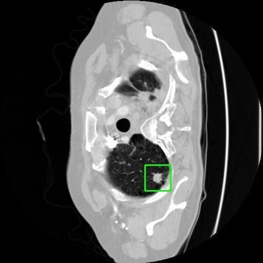 LUNG CANCER DETECTION AND ANALAYSIS WITH AI  – screenshot 22