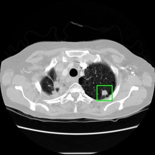 LUNG CANCER DETECTION AND ANALAYSIS WITH AI  – screenshot 23