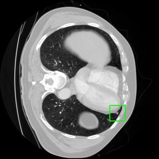 LUNG CANCER DETECTION AND ANALAYSIS WITH AI  – screenshot 24