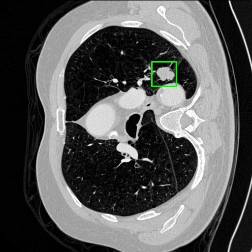 LUNG CANCER DETECTION AND ANALAYSIS WITH AI  – screenshot 26