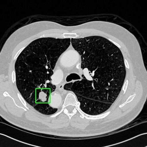 LUNG CANCER DETECTION AND ANALAYSIS WITH AI  – screenshot 27