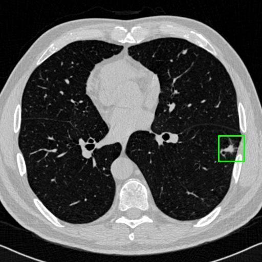 LUNG CANCER DETECTION AND ANALAYSIS WITH AI  – screenshot 28