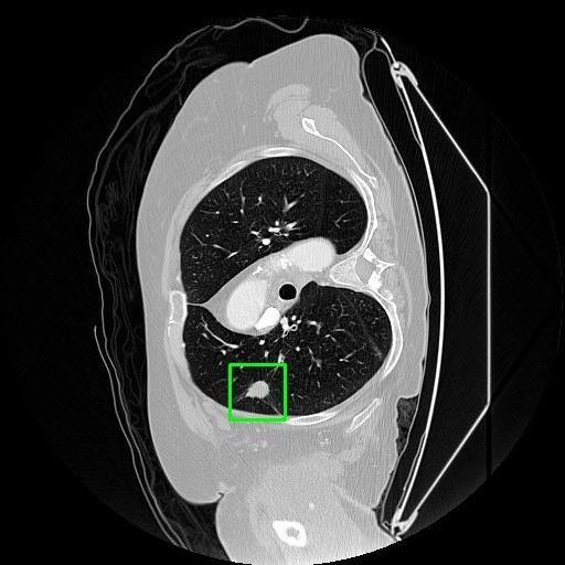 LUNG CANCER DETECTION AND ANALAYSIS WITH AI  – screenshot 29