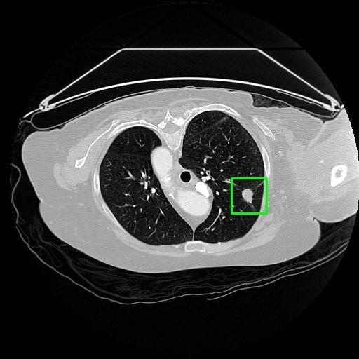 LUNG CANCER DETECTION AND ANALAYSIS WITH AI  – screenshot 30