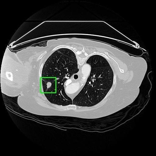 LUNG CANCER DETECTION AND ANALAYSIS WITH AI  – screenshot 31