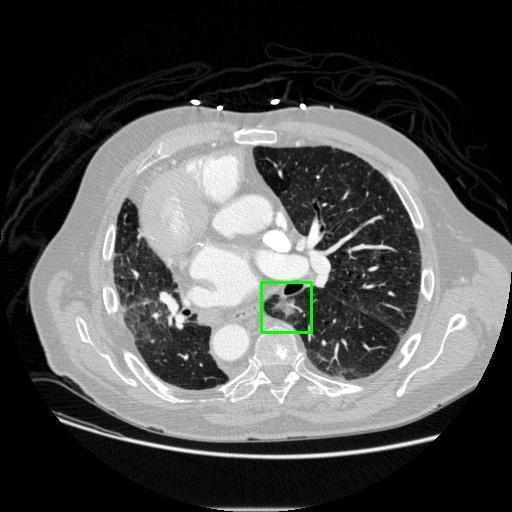LUNG CANCER DETECTION AND ANALAYSIS WITH AI  – screenshot 32
