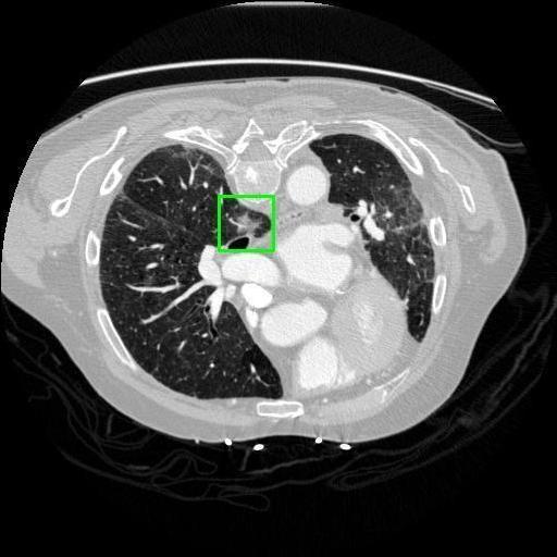 LUNG CANCER DETECTION AND ANALAYSIS WITH AI  – screenshot 33