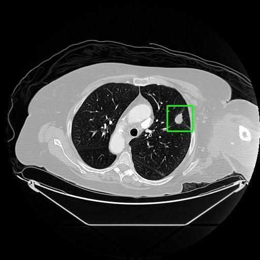 LUNG CANCER DETECTION AND ANALAYSIS WITH AI  – screenshot 34