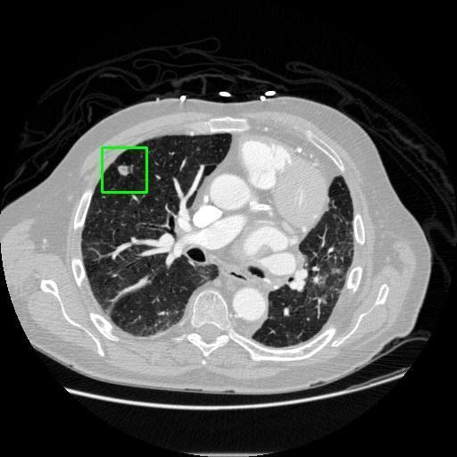 LUNG CANCER DETECTION AND ANALAYSIS WITH AI  – screenshot 35