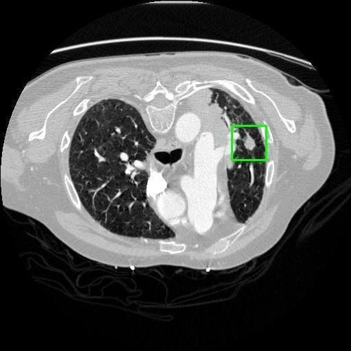 LUNG CANCER DETECTION AND ANALAYSIS WITH AI  – screenshot 36