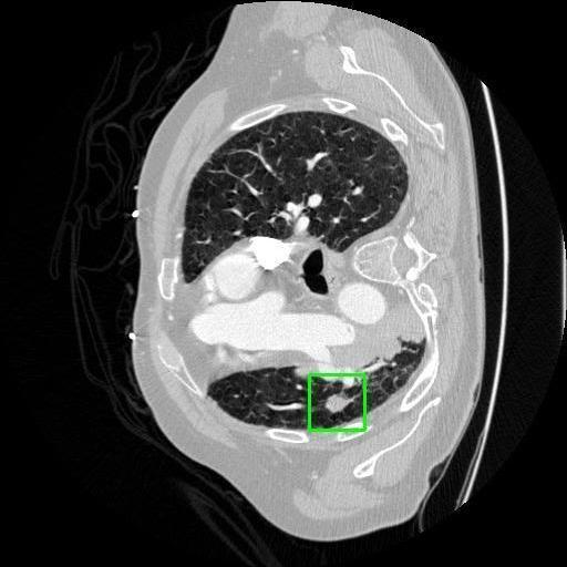 LUNG CANCER DETECTION AND ANALAYSIS WITH AI  – screenshot 38
