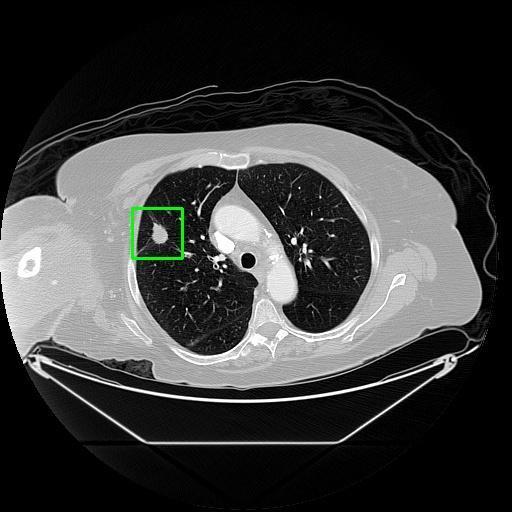 LUNG CANCER DETECTION AND ANALAYSIS WITH AI  – screenshot 39