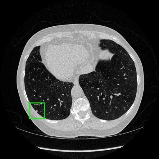 LUNG CANCER DETECTION AND ANALAYSIS WITH AI  – screenshot 40