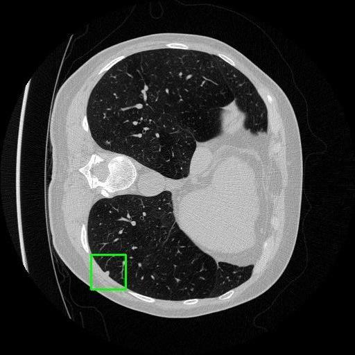 LUNG CANCER DETECTION AND ANALAYSIS WITH AI  – screenshot 41