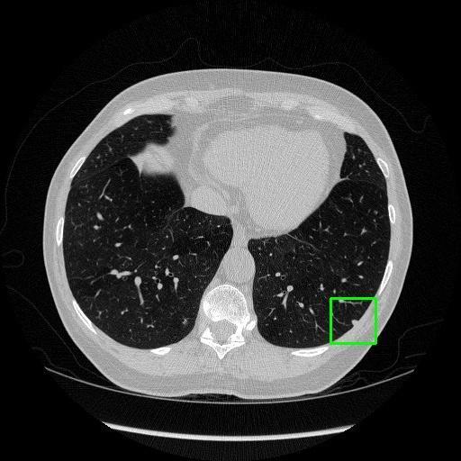 LUNG CANCER DETECTION AND ANALAYSIS WITH AI  – screenshot 44