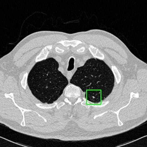 LUNG CANCER DETECTION AND ANALAYSIS WITH AI  – screenshot 45