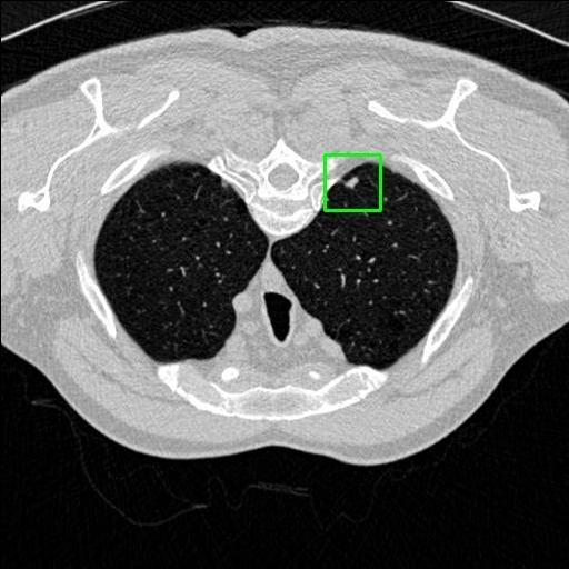 LUNG CANCER DETECTION AND ANALAYSIS WITH AI  – screenshot 47