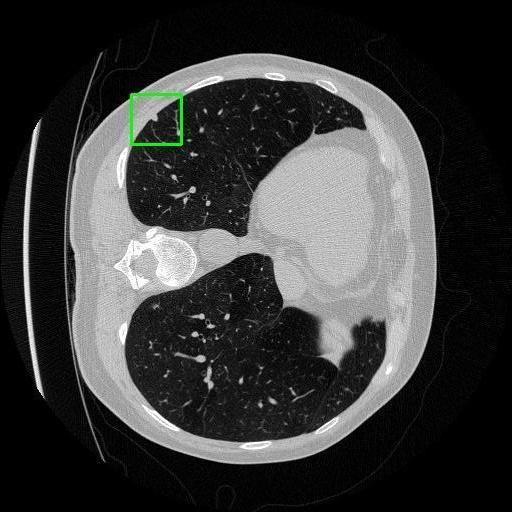 LUNG CANCER DETECTION AND ANALAYSIS WITH AI  – screenshot 48