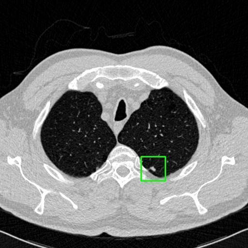 LUNG CANCER DETECTION AND ANALAYSIS WITH AI  – screenshot 50