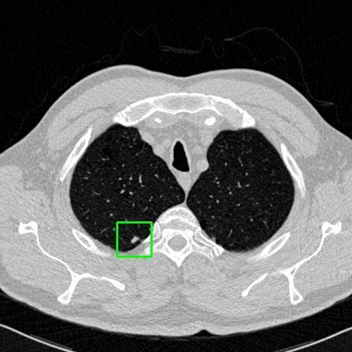 LUNG CANCER DETECTION AND ANALAYSIS WITH AI  – screenshot 51