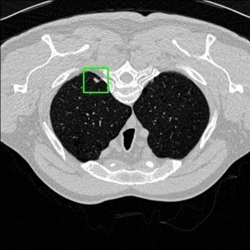 LUNG CANCER DETECTION AND ANALAYSIS WITH AI  – screenshot 52