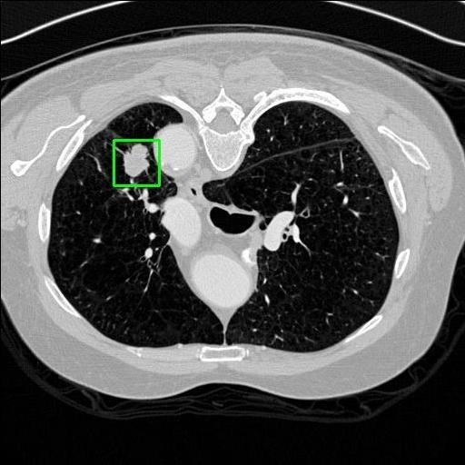 LUNG CANCER DETECTION AND ANALAYSIS WITH AI  – screenshot 53