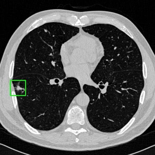 LUNG CANCER DETECTION AND ANALAYSIS WITH AI  – screenshot 54