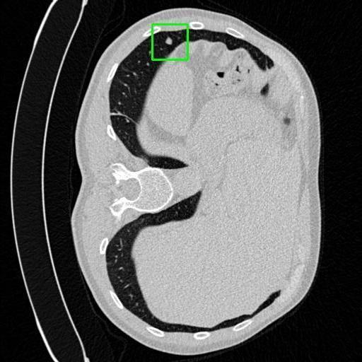 LUNG CANCER DETECTION AND ANALAYSIS WITH AI  – screenshot 56