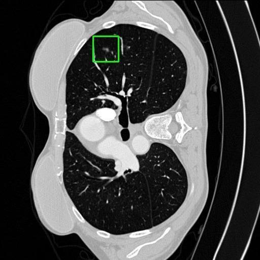 LUNG CANCER DETECTION AND ANALAYSIS WITH AI  – screenshot 57