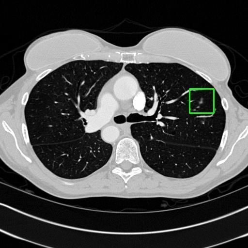 LUNG CANCER DETECTION AND ANALAYSIS WITH AI  – screenshot 58