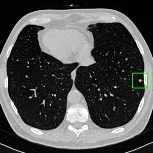 LUNG CANCER DETECTION AND ANALAYSIS WITH AI  – screenshot 60