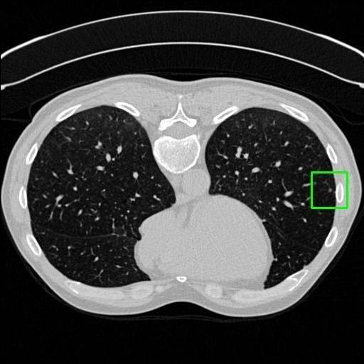 LUNG CANCER DETECTION AND ANALAYSIS WITH AI  – screenshot 61