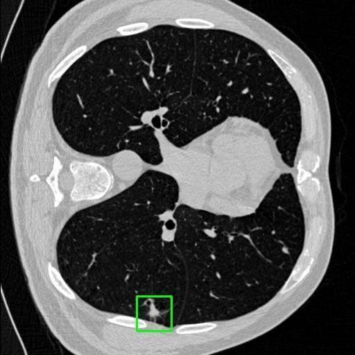 LUNG CANCER DETECTION AND ANALAYSIS WITH AI  – screenshot 62