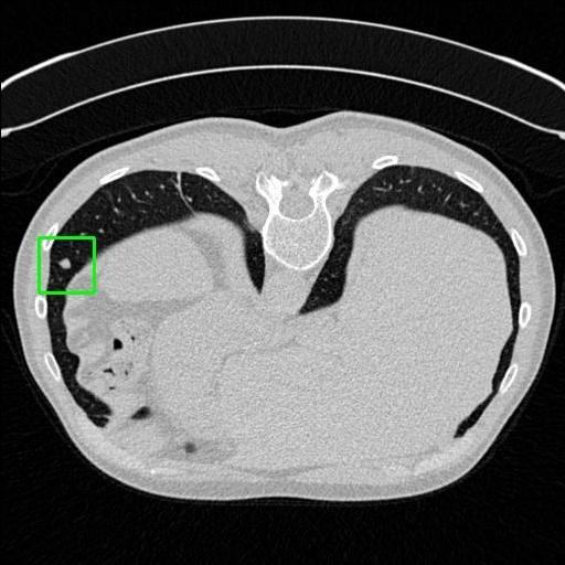 LUNG CANCER DETECTION AND ANALAYSIS WITH AI  – screenshot 63
