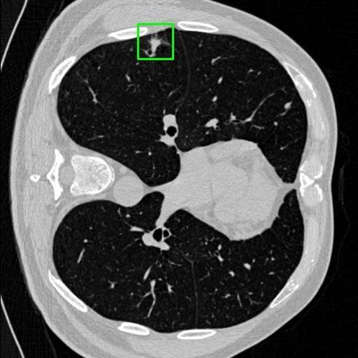 LUNG CANCER DETECTION AND ANALAYSIS WITH AI  – screenshot 64