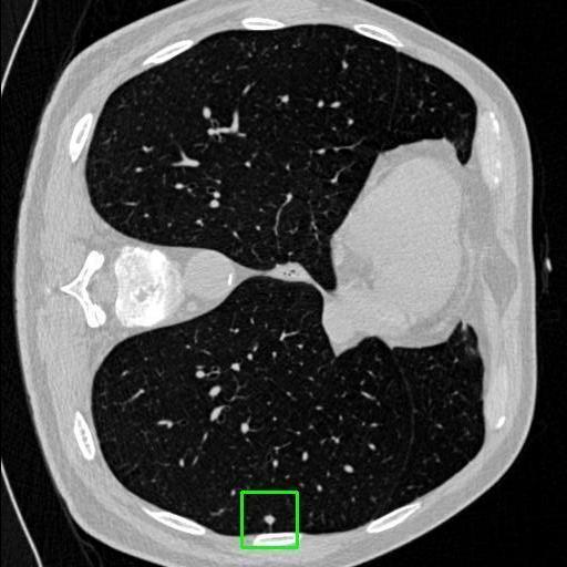 LUNG CANCER DETECTION AND ANALAYSIS WITH AI  – screenshot 65