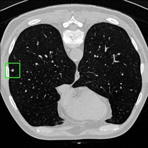 LUNG CANCER DETECTION AND ANALAYSIS WITH AI  – screenshot 66
